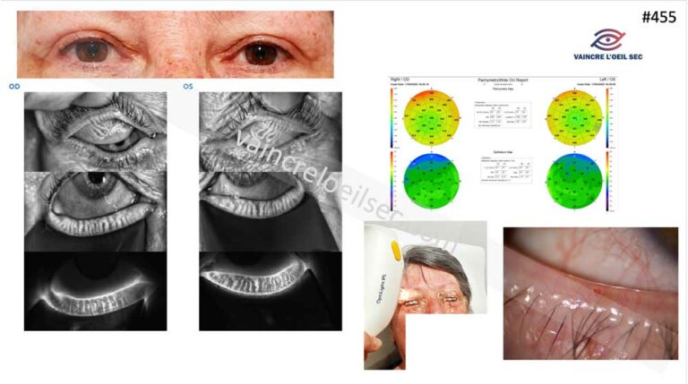 La Rosacée Oculaire en Cas Cliniques Commentés - Vaincre l'Oeil Sec