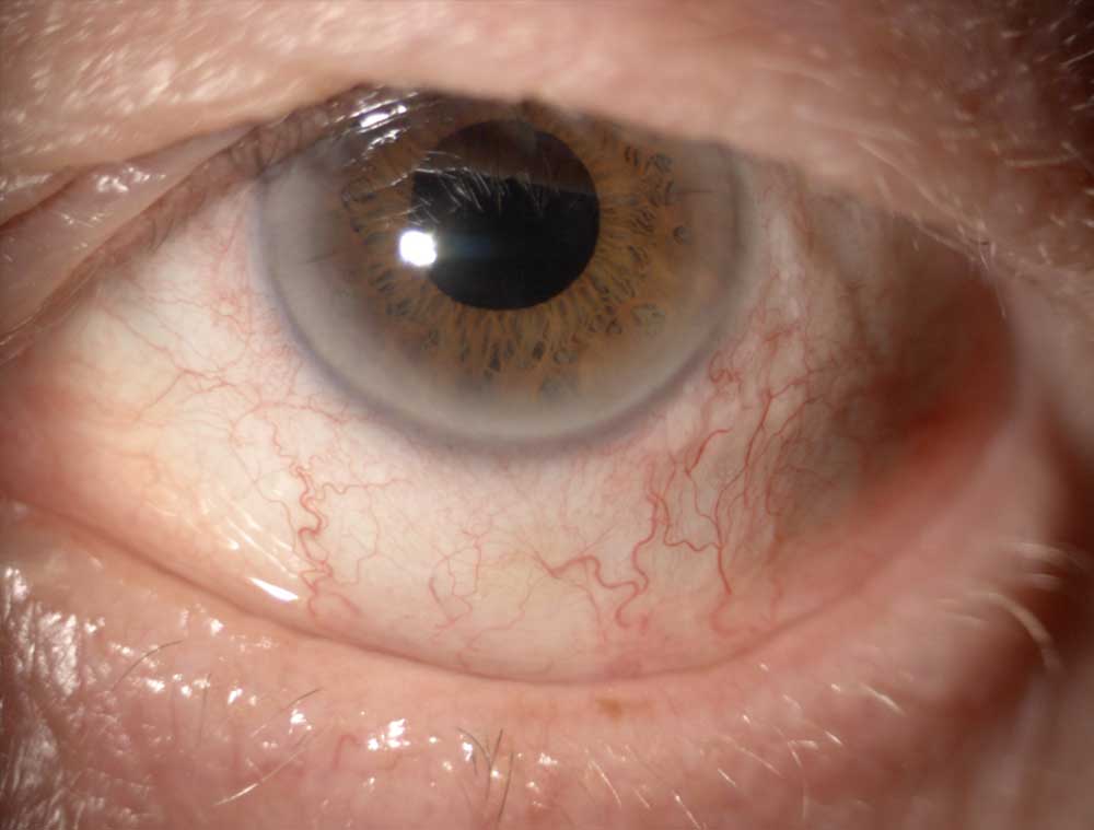 Le syndrome de flaccidité palpébrale est une malposition bilatérale des paupières, qui concerne généralement les paupières supérieures et se manifeste par une irritation récurrente ou chronique de la surface oculaire.