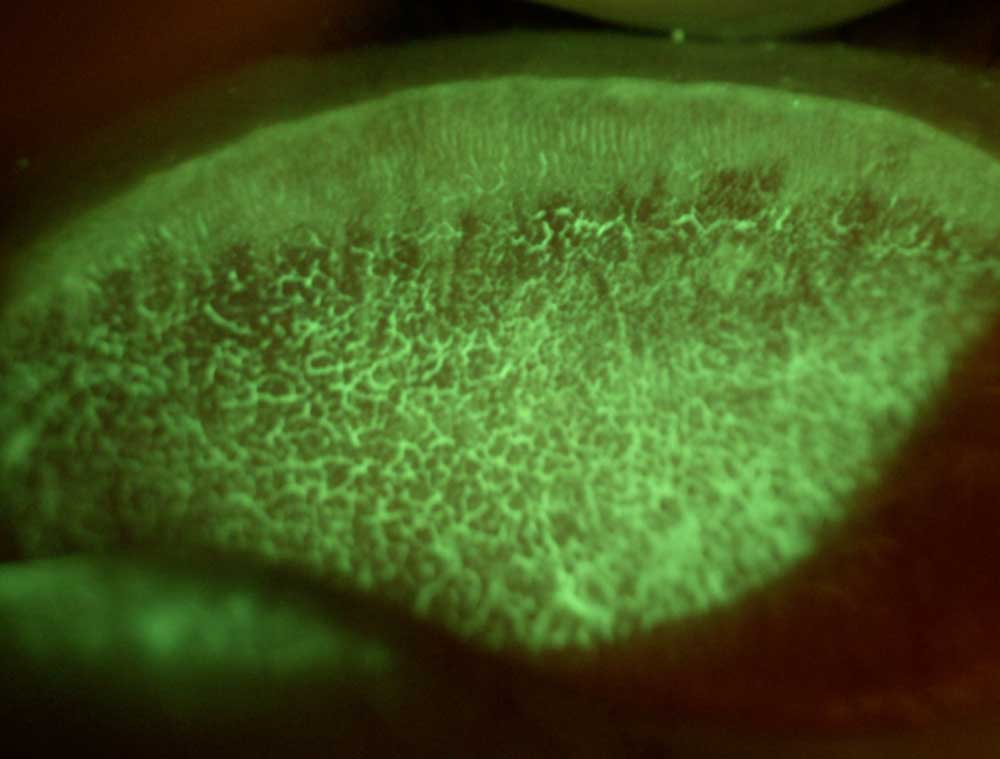 L’épithéliopathie en essui-glace ou Lid Wiper Epitheliopathy (LWE) des anglo-saxons, résulte d’une irritation chronique du bord libre des paupières et se traduit lors de l’éversion des paupières par une ligne horizontale prenant les colorants comme la fluorescéine.