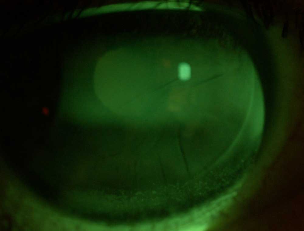 Lors de la réalisation d’un LASIK, la découpe cornéenne au laser femtoseconde (première étape du LASIK) implique la section des filets nerveux antérieurs, brisant ainsi l’arc réflexe lacrymo-cornéen, ce qui aboutit à une réduction de la sécrétion des larmes et à une sécheresse oculaire constante