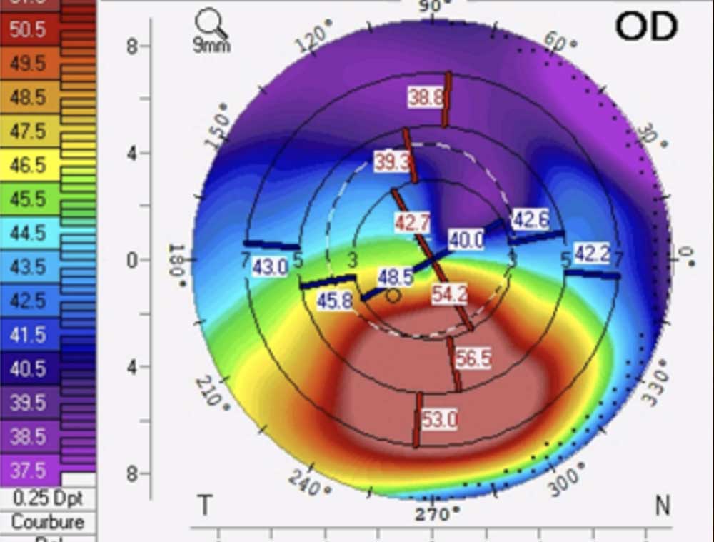 On parle de kératocône lorsque la cornée s'amincit et se bombe comme un cône. La modification entraîne une défocalisation des rayons lumineux, ce qui induit une vision floue et déformée, rendant difficiles les tâches quotidiennes telles que la lecture et la conduite.